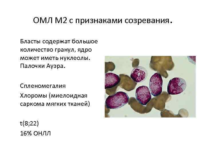 ОМЛ M 2 с признаками созревания. Бласты содержат большое количество гранул, ядро может иметь