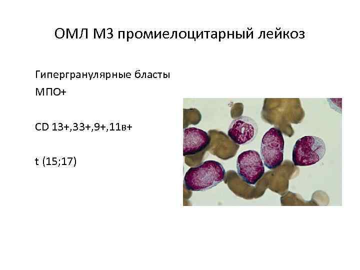 Острый миелоидный лейкоз тесты нмо. Острый промиелоцитарный лейкоз м3. Острый лейкоз бласты. Острый миелобластный лейкоз м4.