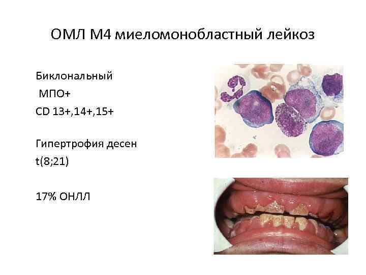 ОМЛ М 4 миеломонобластный лейкоз Биклональный МПО+ СD 13+, 14+, 15+ Гипертрофия десен t(8;