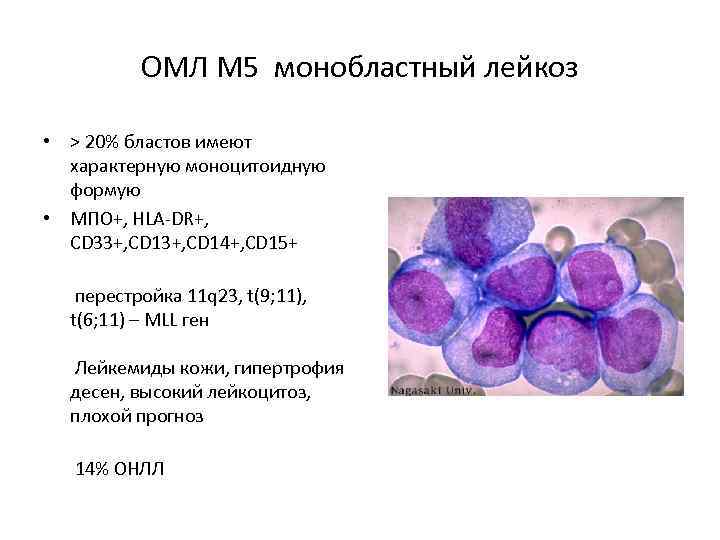 Острый миелоидный лейкоз прогноз. Острый миелобластный лейкоз вариант м5. Острый миелобластный лейкоз картина крови. Острый миелоидный лейкоз м0. Острый монобластный лейкоз анализ крови.
