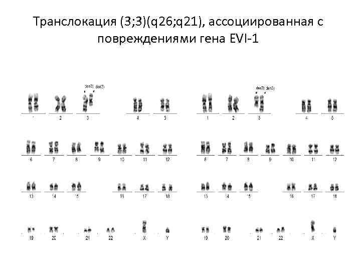 Транслокация (3; 3)(q 26; q 21), ассоциированная с повреждениями гена EVI-1 