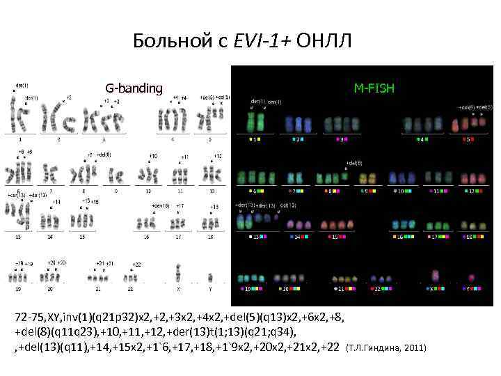 Больной с EVI-1+ ОНЛЛ G-banding M-FISH 72 -75, XY, inv(1)(q 21 p 32)x 2,