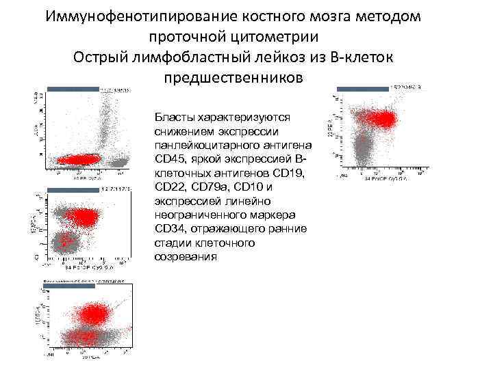 Иммунофенотипирование костного мозга методом проточной цитометрии Острый лимфобластный лейкоз из В-клеток предшественников Бласты характеризуются