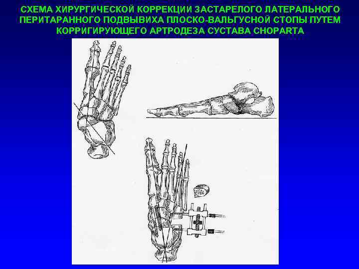 СХЕМА ХИРУРГИЧЕСКОЙ КОРРЕКЦИИ ЗАСТАРЕЛОГО ЛАТЕРАЛЬНОГО ПЕРИТАРАННОГО ПОДВЫВИХА ПЛОСКО-ВАЛЬГУСНОЙ СТОПЫ ПУТЕМ КОРРИГИРУЮЩЕГО АРТРОДЕЗА СУСТАВА CHOPARTA