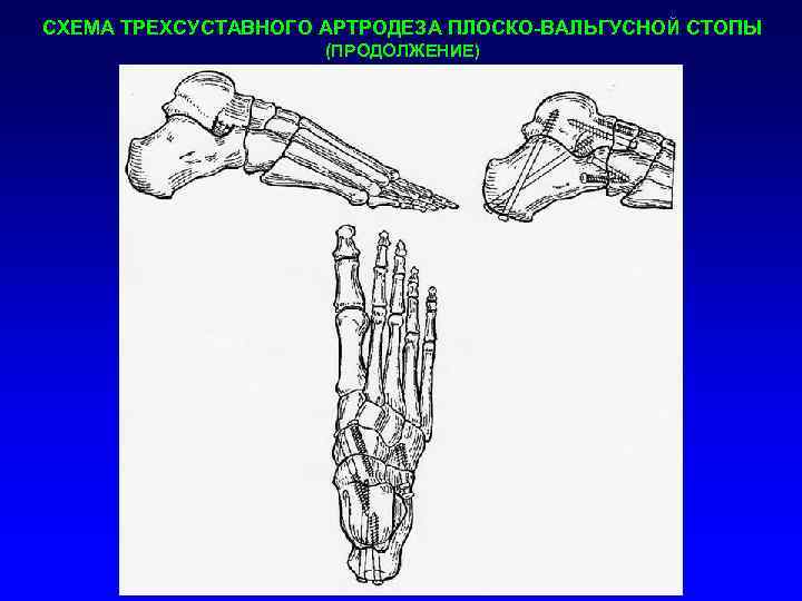 СХЕМА ТРЕХСУСТАВНОГО АРТРОДЕЗА ПЛОСКО-ВАЛЬГУСНОЙ СТОПЫ (ПРОДОЛЖЕНИЕ) 