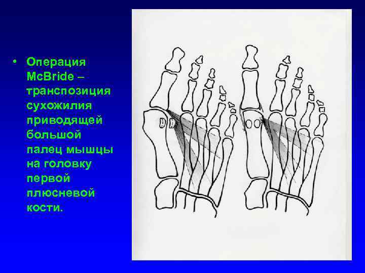  • Операция Mc. Bride – транспозиция сухожилия приводящей большой палец мышцы на головку