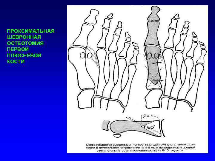 ПРОКСИМАЛЬНАЯ ШЕВРОННАЯ ОСТЕОТОМИЯ ПЕРВОЙ ПЛЮСНЕВОЙ КОСТИ 