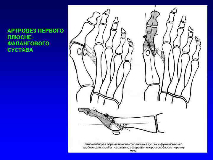АРТРОДЕЗ ПЕРВОГО ПЛЮСНЕФАЛАНГОВОГО СУСТАВА 