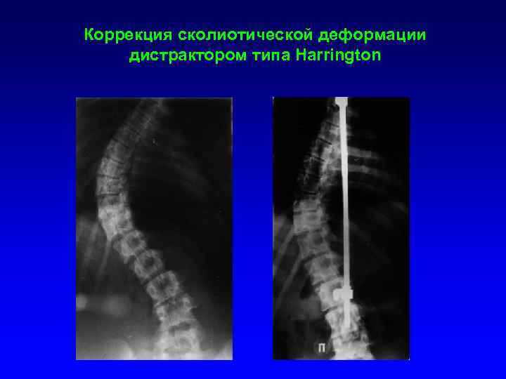 Коррекция сколиотической деформации дистрактором типа Harrington 