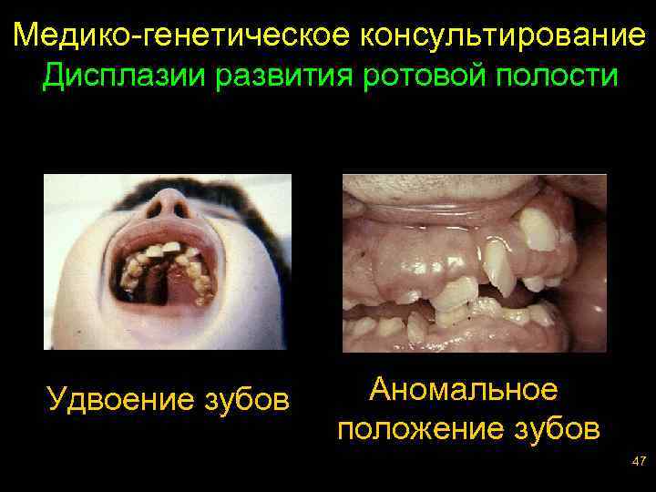 Медико-генетическое консультирование Дисплазии развития ротовой полости Удвоение зубов Аномальное положение зубов 47 