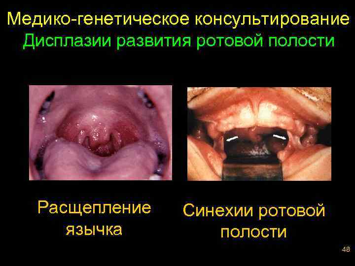 Медико-генетическое консультирование Дисплазии развития ротовой полости Расщепление язычка Синехии ротовой полости 48 