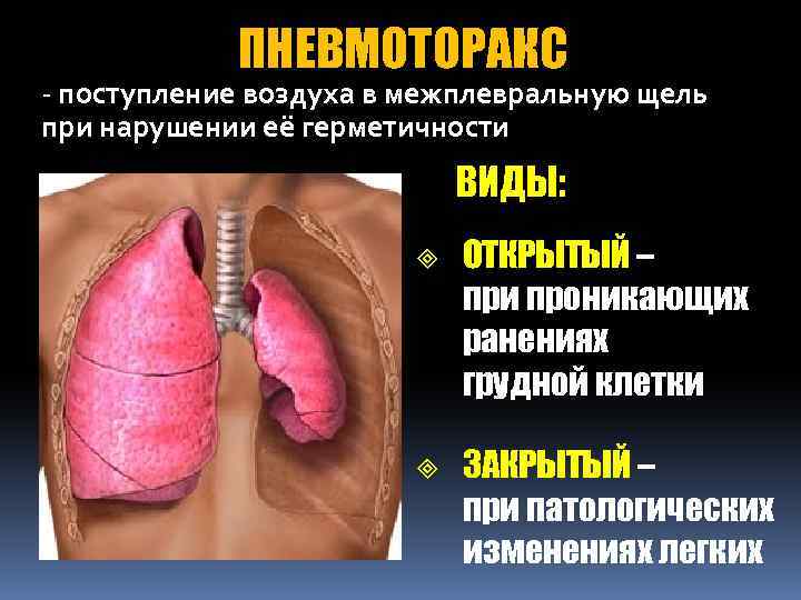 ПНЕВМОТОРАКС - поступление воздуха в межплевральную щель при нарушении её герметичности ВИДЫ: ³ ³
