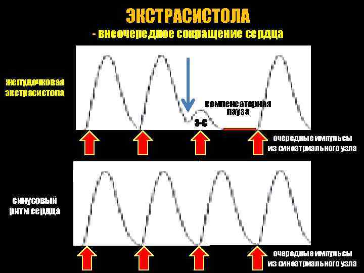 ЭКСТРАСИСТОЛА - внеочередное сокращение сердца желудочковая экстрасистола компенсаторная пауза Э-С очередные импульсы из синоатриального