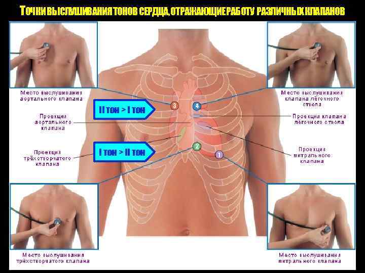 ТОЧКИ ВЫСЛУШИВАНИЯ ТОНОВ СЕРДЦА, ОТРАЖАЮЩИЕ РАБОТУ РАЗЛИЧНЫХ КЛАПАНОВ II тон > II тон 3
