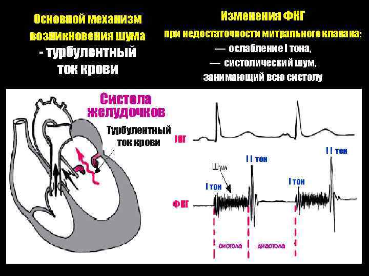 Основной механизм возникновения шума - турбулентный ток крови Изменения ФКГ при недостаточности митрального клапана: