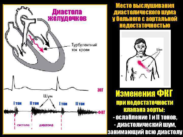 Место выслушивания диастолического шума у больного с аортальной недостаточностью Диаcтола желудочков ЭКГ I тон