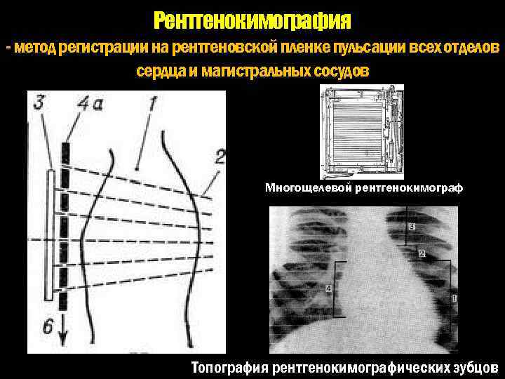 Рентгенокимография - метод регистрации на рентгеновской пленке пульсации всех отделов сердца и магистральных сосудов