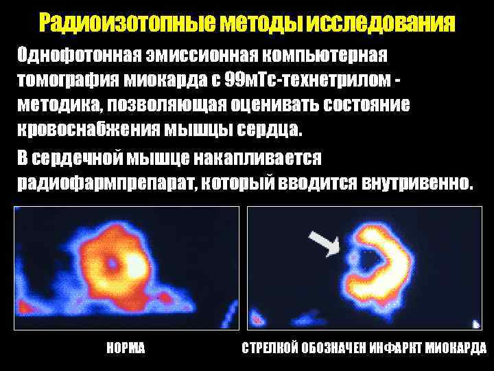 Радиоизотопные методы исследования Однофотонная эмиссионная компьютерная томография миокарда с 99 м. Тс-технетрилом методика, позволяющая