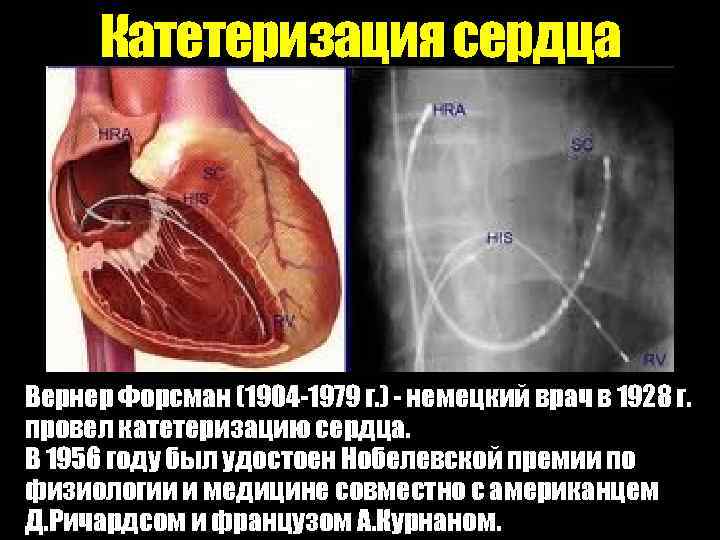 Катетеризация сердца Вернер Форсман (1904 -1979 г. ) - немецкий врач в 1928 г.