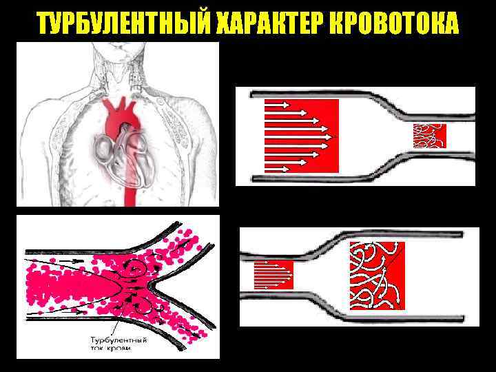 ТУРБУЛЕНТНЫЙ ХАРАКТЕР КРОВОТОКА 