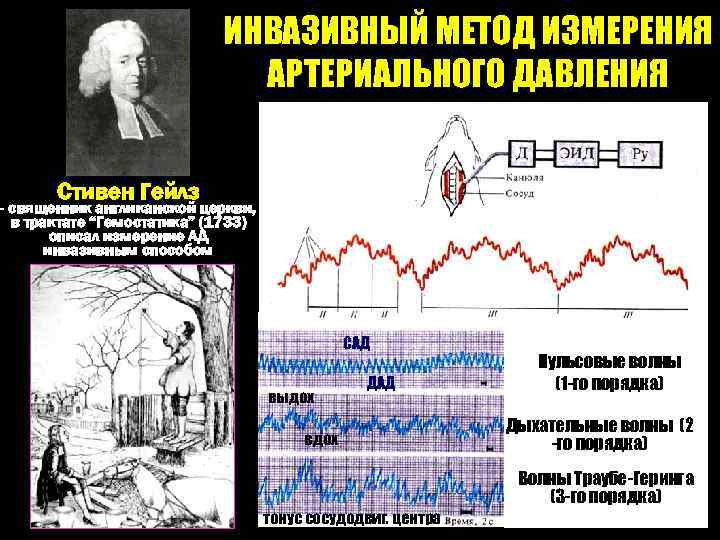 ИНВАЗИВНЫЙ МЕТОД ИЗМЕРЕНИЯ АРТЕРИАЛЬНОГО ДАВЛЕНИЯ Стивен Гейлз - священник англиканской церкви, в трактате “Гемостатика”