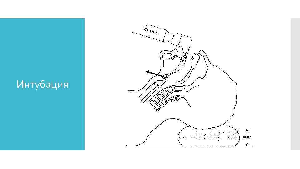 Интубация 