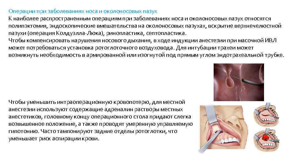 Операции при заболеваниях носа и околоносовых пазух К наиболее распространенным операциям при заболеваниях носа