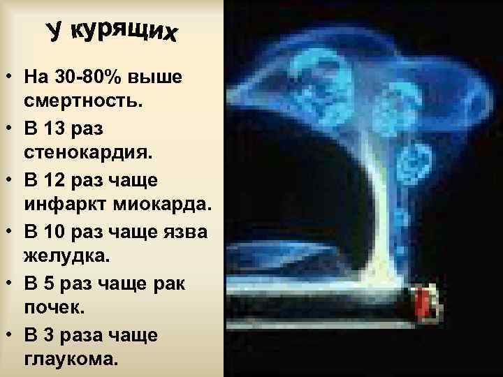  • На 30 -80% выше смертность. • В 13 раз стенокардия. • В