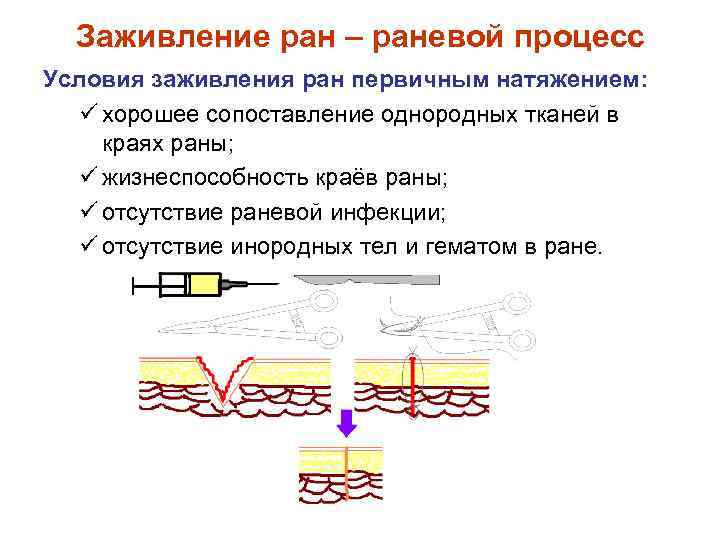 Заживление ран – раневой процесс Условия заживления ран первичным натяжением: ü хорошее сопоставление однородных