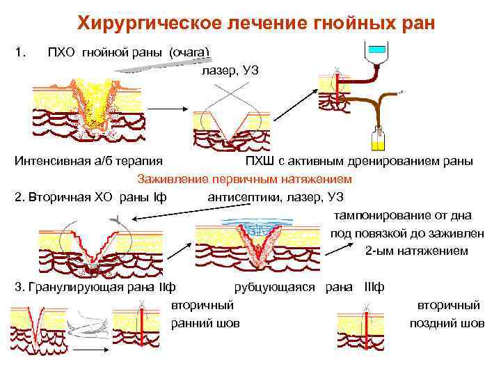 Хирургическое лечение гнойных ран 1. ПХО гнойной раны (очага) лазер, УЗ Интенсивная а/б терапия