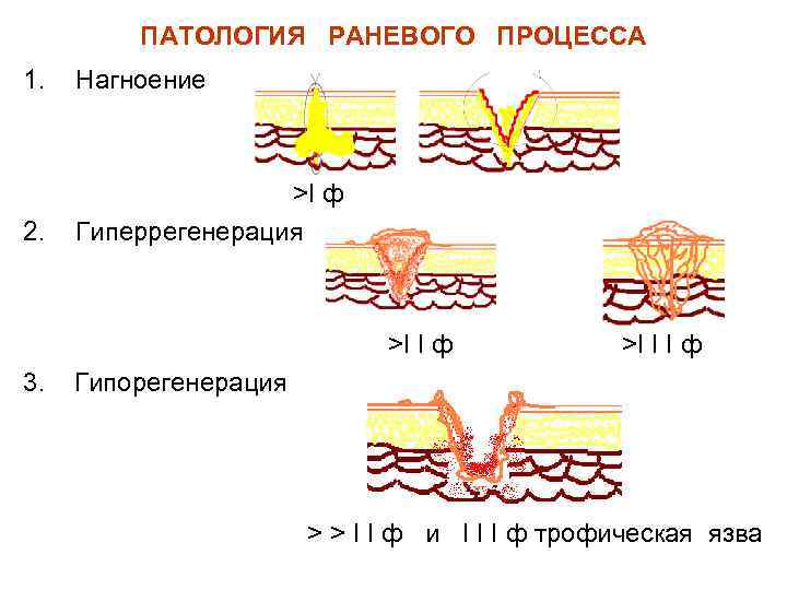 ПАТОЛОГИЯ РАНЕВОГО ПРОЦЕССА 1. Нагноение 2. >I ф Гиперрегенерация >I I ф 3. >I