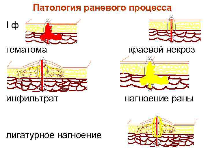 Патология раневого процесса Iф гематома инфильтрат лигатурное нагноение краевой некроз нагноение раны 