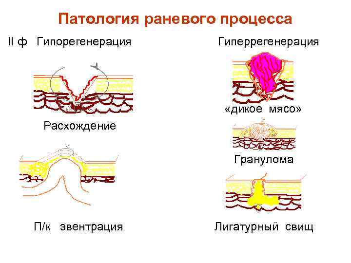 Патология раневого процесса II ф Гипорегенерация Гиперрегенерация «дикое мясо» Расхождение Гранулома П/к эвентрация Лигатурный