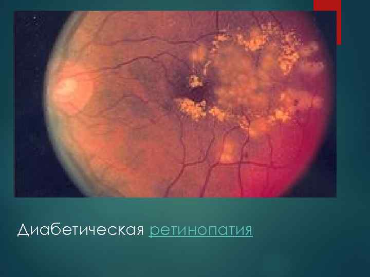 Диабетическая ретинопатия 