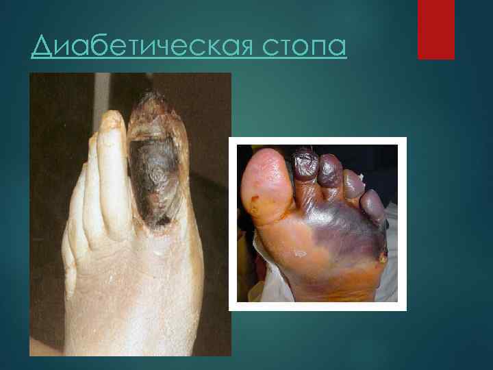 Диабетическая стопа 
