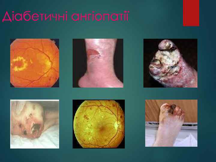 Діабетичні ангіопатії 