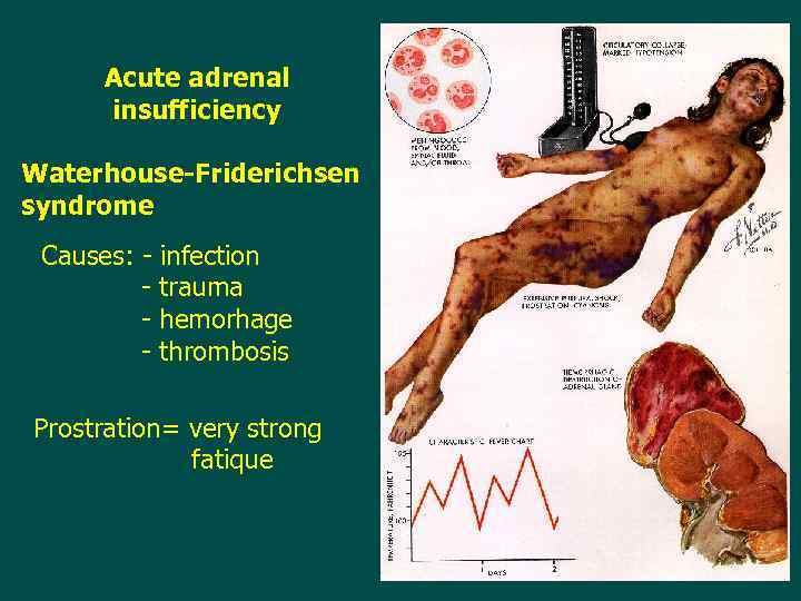 Acute adrenal insufficiency Waterhouse-Friderichsen syndrome Causes: - infection - trauma - hemorhage - thrombosis