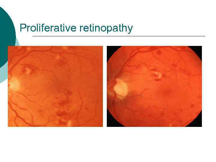 Proliferative retinopathy 