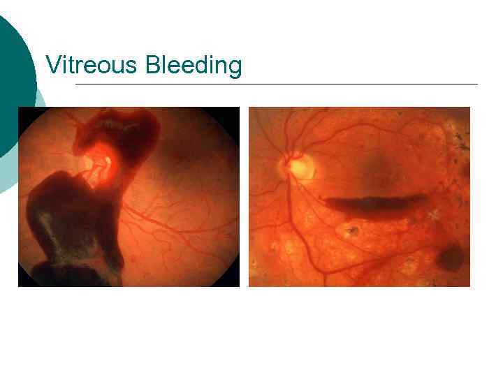 Vitreous Bleeding 