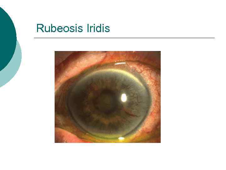 Rubeosis Iridis 