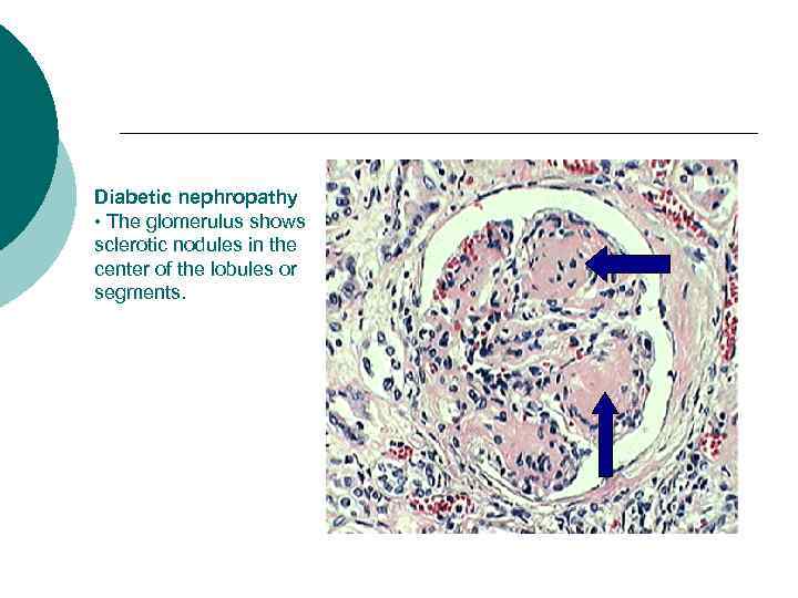 Diabetic nephropathy • The glomerulus shows sclerotic nodules in the center of the lobules