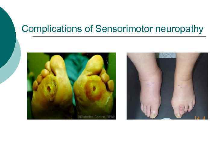 Complications of Sensorimotor neuropathy 