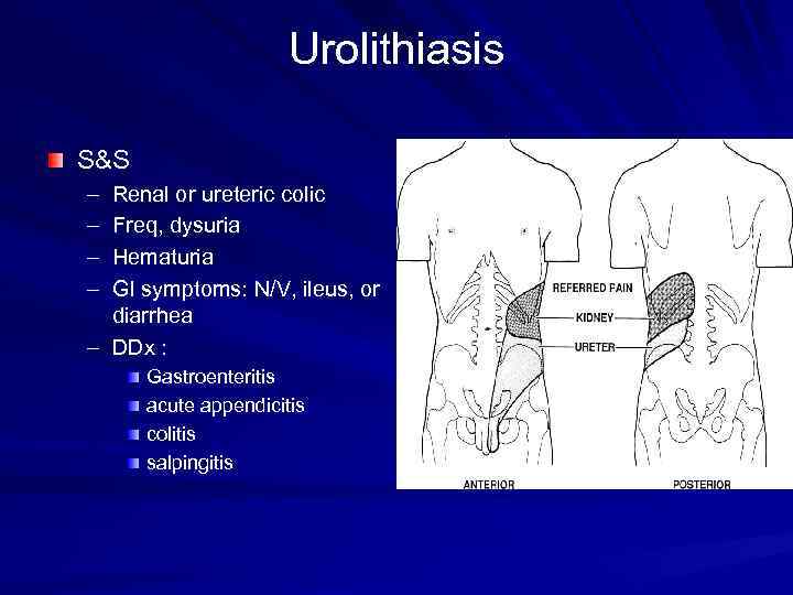 Urolithiasis S&S – – Renal or ureteric colic Freq, dysuria Hematuria GI symptoms: N/V,