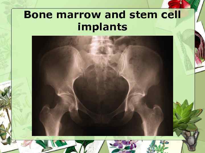 Bone marrow and stem cell implants 