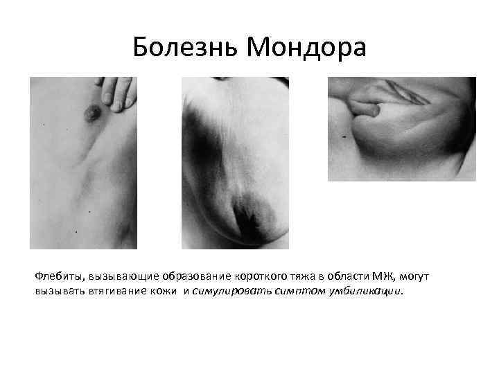 Болезнь Мондора Флебиты, вызывающие образование короткого тяжа в области МЖ, могут вызывать втягивание кожи