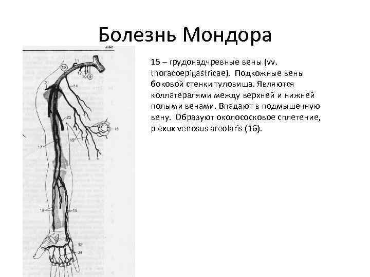Болезнь Мондора 15 – грудонадчревные вены (vv. thoracoepigastricae). Подкожные вены боковой стенки туловища. Являются
