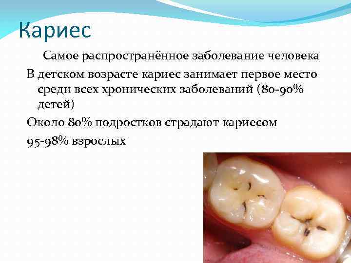 Кариес Самое распространённое заболевание человека В детском возрасте кариес занимает первое место среди всех