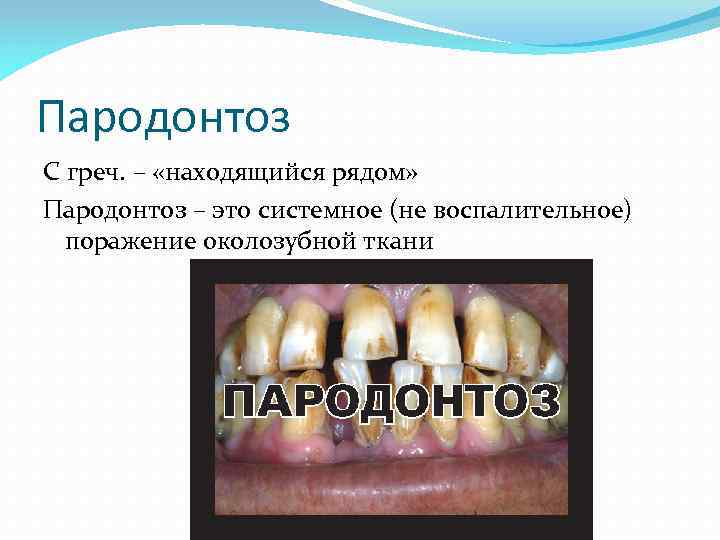 Пародонтоз С греч. – «находящийся рядом» Пародонтоз – это системное (не воспалительное) поражение околозубной