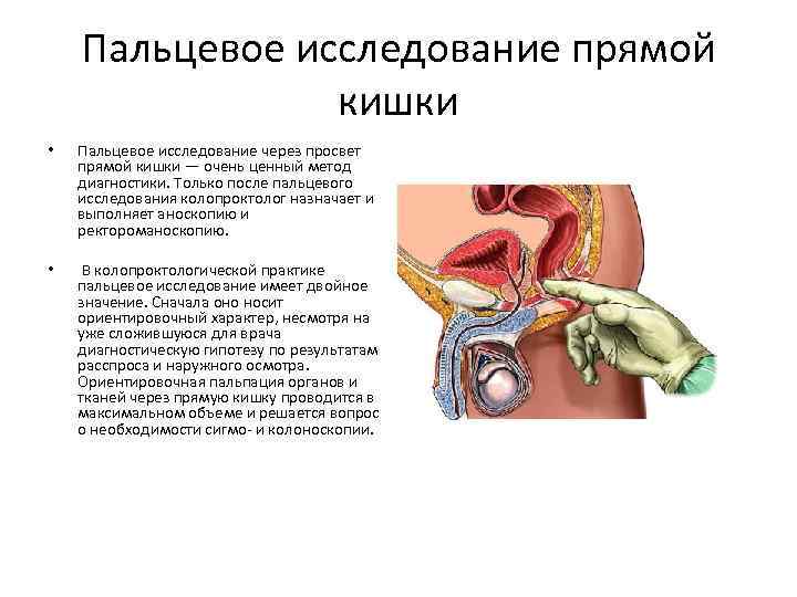 Пальцевое исследование прямой кишки • Пальцевое исследование через просвет прямой кишки — очень ценный