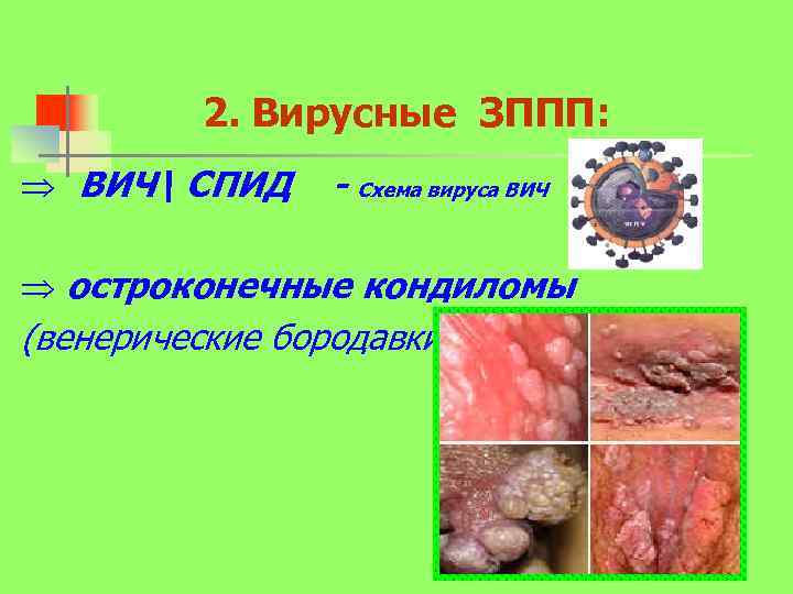2. Вирусные ЗППП: ВИЧ СПИД - Схема вируса ВИЧ остроконечные кондиломы (венерические бородавки); 
